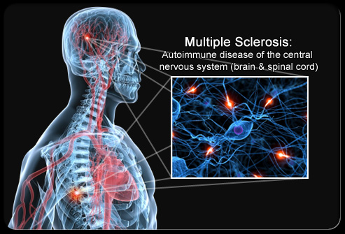 [تصویر: multiple-sclerosis-s1-brain-spinal-cord-nerves.jpg]